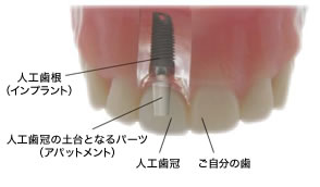 歯科インプラントとは?
