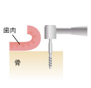骨に穴を開けます