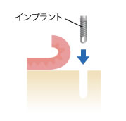 骨の穴にインプラントを埋入します