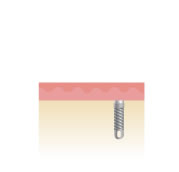 骨の穴にインプラントを埋入します