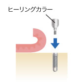 インプラント頭部にヒーリングカラーを装着します