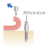 骨の穴にインプラントを埋入します
