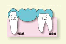 骨に穴を開けます
