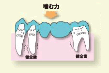 抜けた歯の両隣の健康な歯を削り、人工の歯(ブリッジ)を被せます。