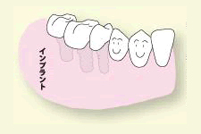 数本のインプラントを植立し、インプラント同士を連結します。入れ歯を固定するバーや止め金が不要となり、口の中もすっきりし、口臭も減ります。